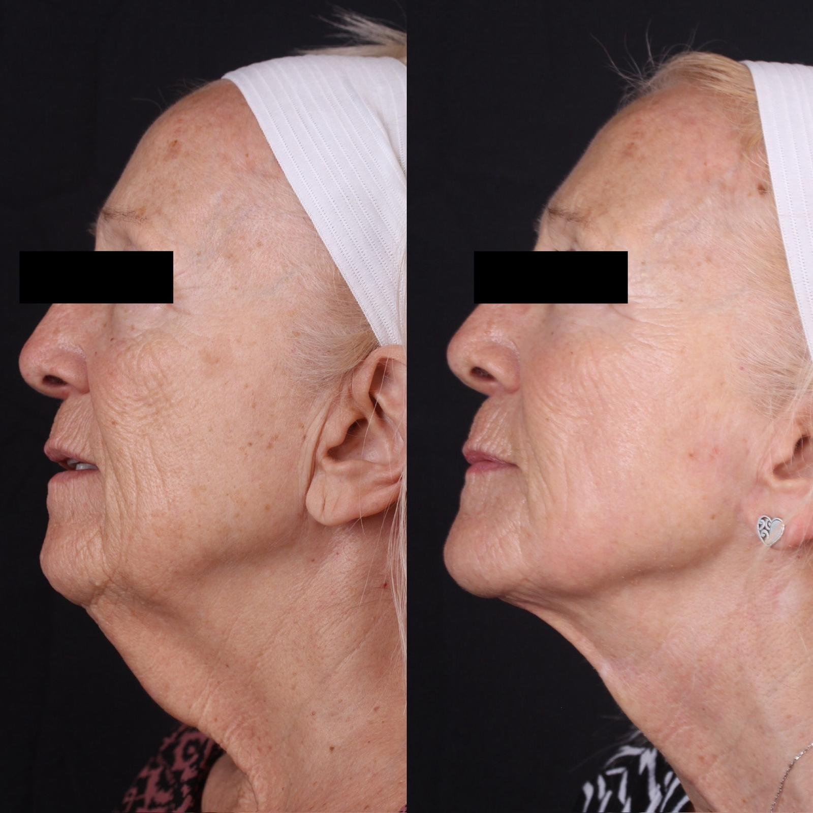 Real patient results before and after plastic surgery results in Beverly Hills, CA, performed by Dr. Moy