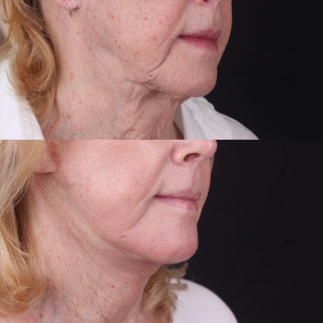 Real patient results before and after plastic surgery results in Beverly Hills, CA, performed by Dr. Moy
