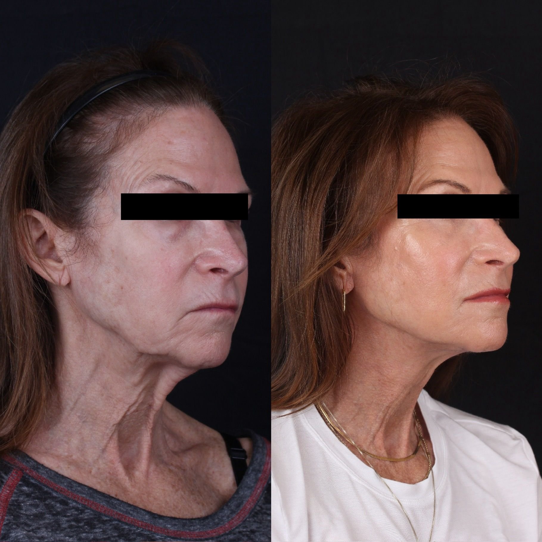 Real patient results before and after plastic surgery results in Beverly Hills, CA, performed by Dr. Moy