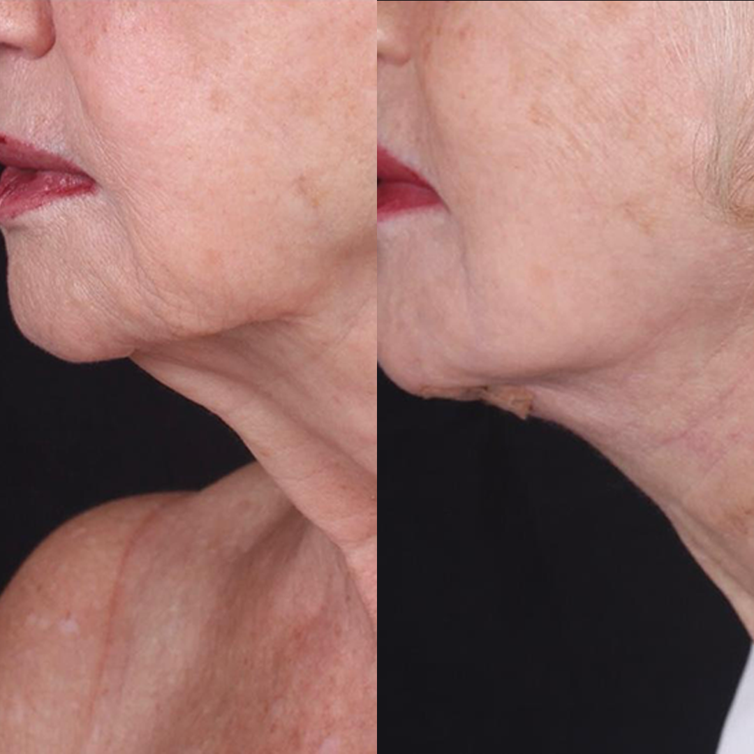 Real patient results before and after plastic surgery results in Beverly Hills, CA, performed by Dr. Moy