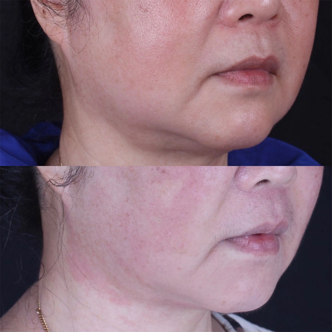 Real patient results before and after plastic surgery results in Beverly Hills, CA, performed by Dr. Moy
