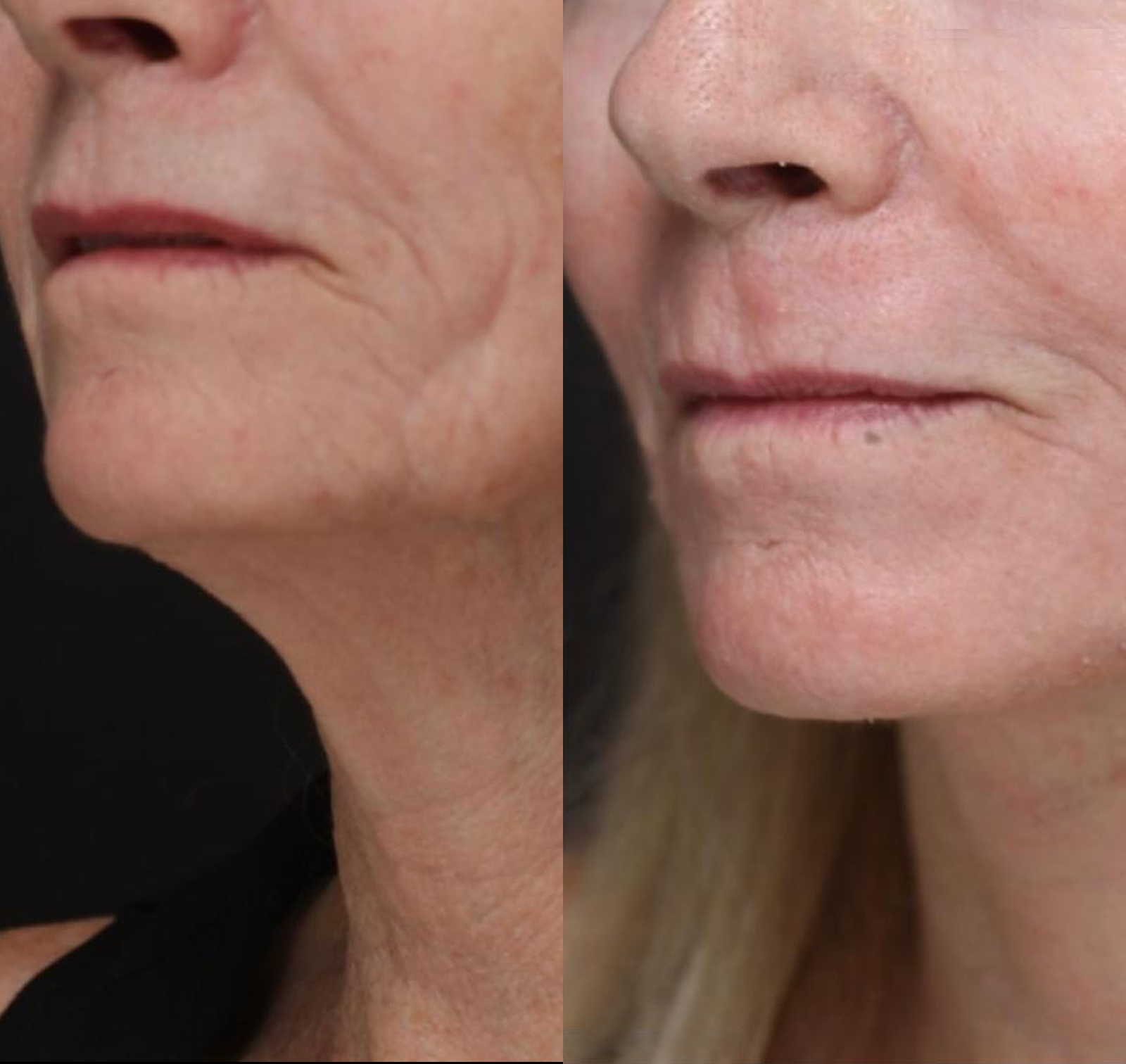 Real patient results before and after plastic surgery results in Beverly Hills, CA, performed by Dr. Moy