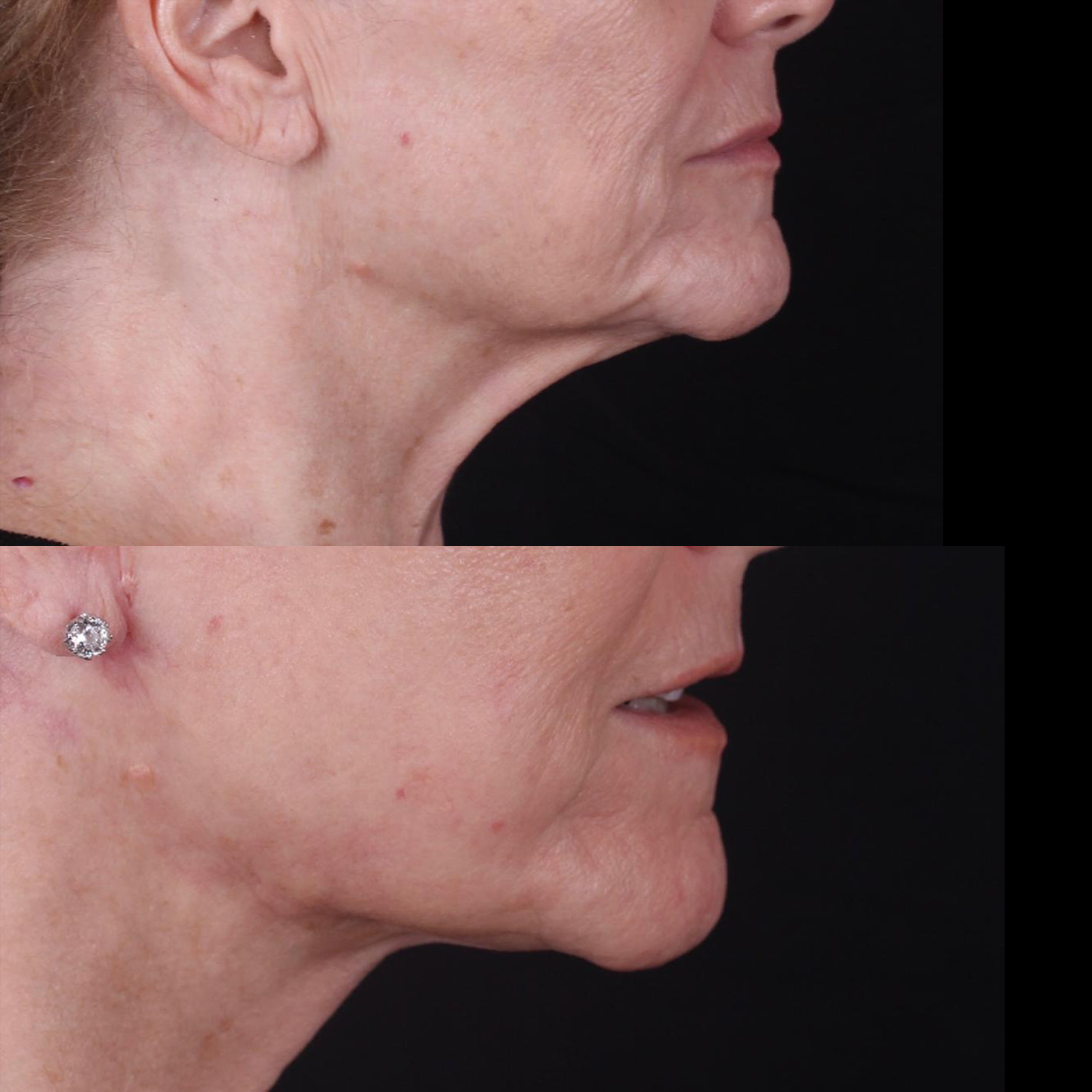 Real patient results before and after plastic surgery results in Beverly Hills, CA, performed by Dr. Moy