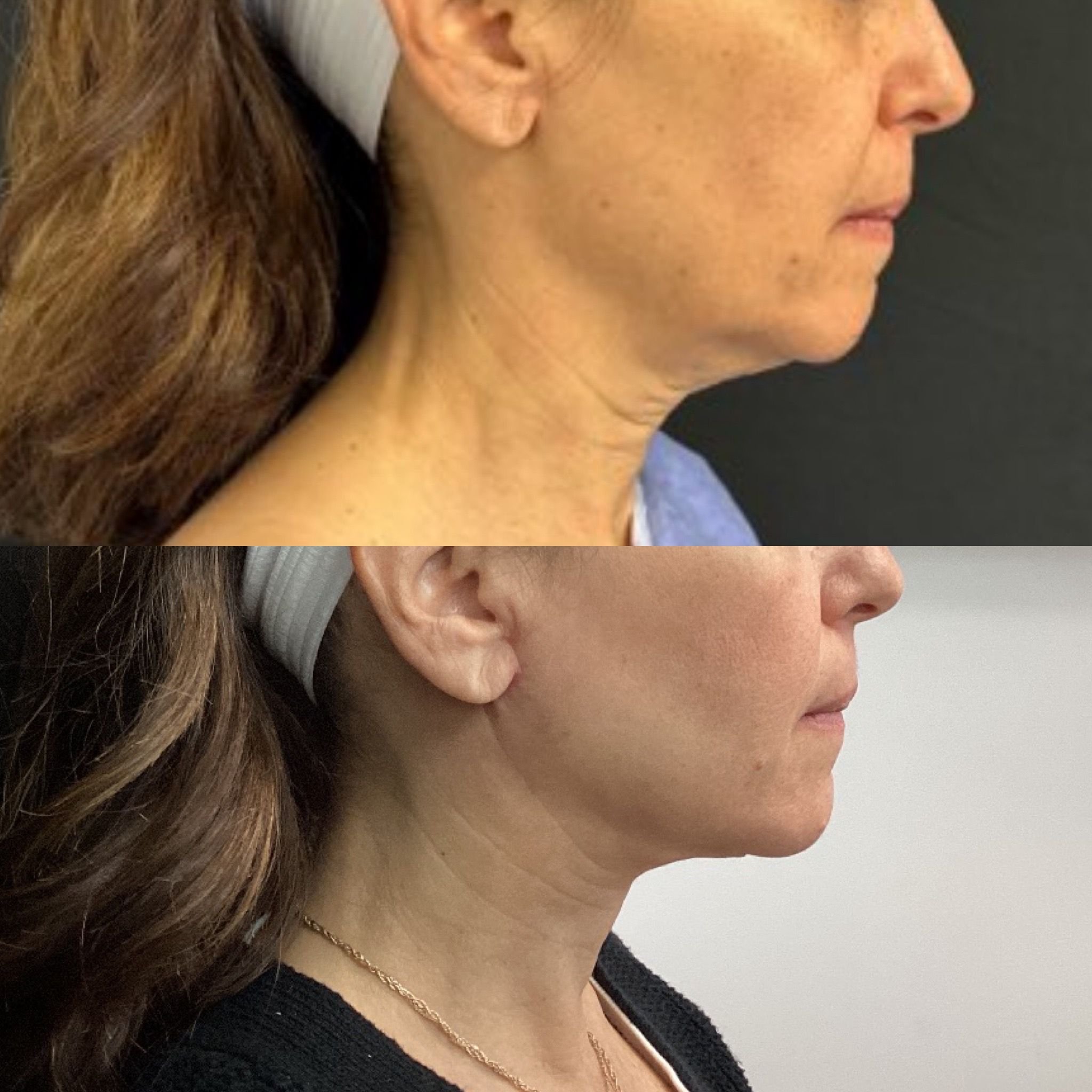 Real patient results before and after plastic surgery results in Beverly Hills, CA, performed by Dr. Moy