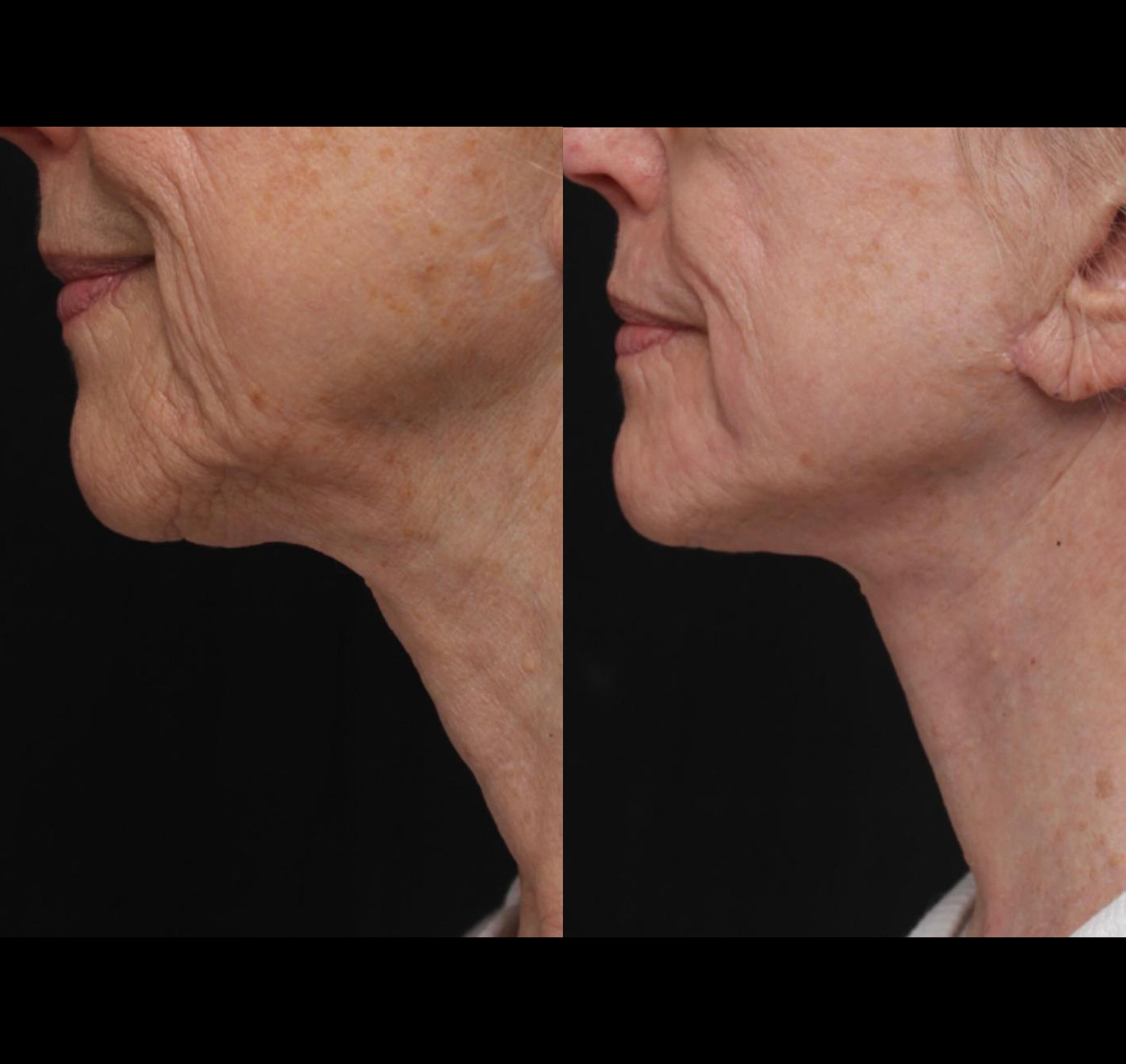 Real patient results before and after plastic surgery results in Beverly Hills, CA, performed by Dr. Moy