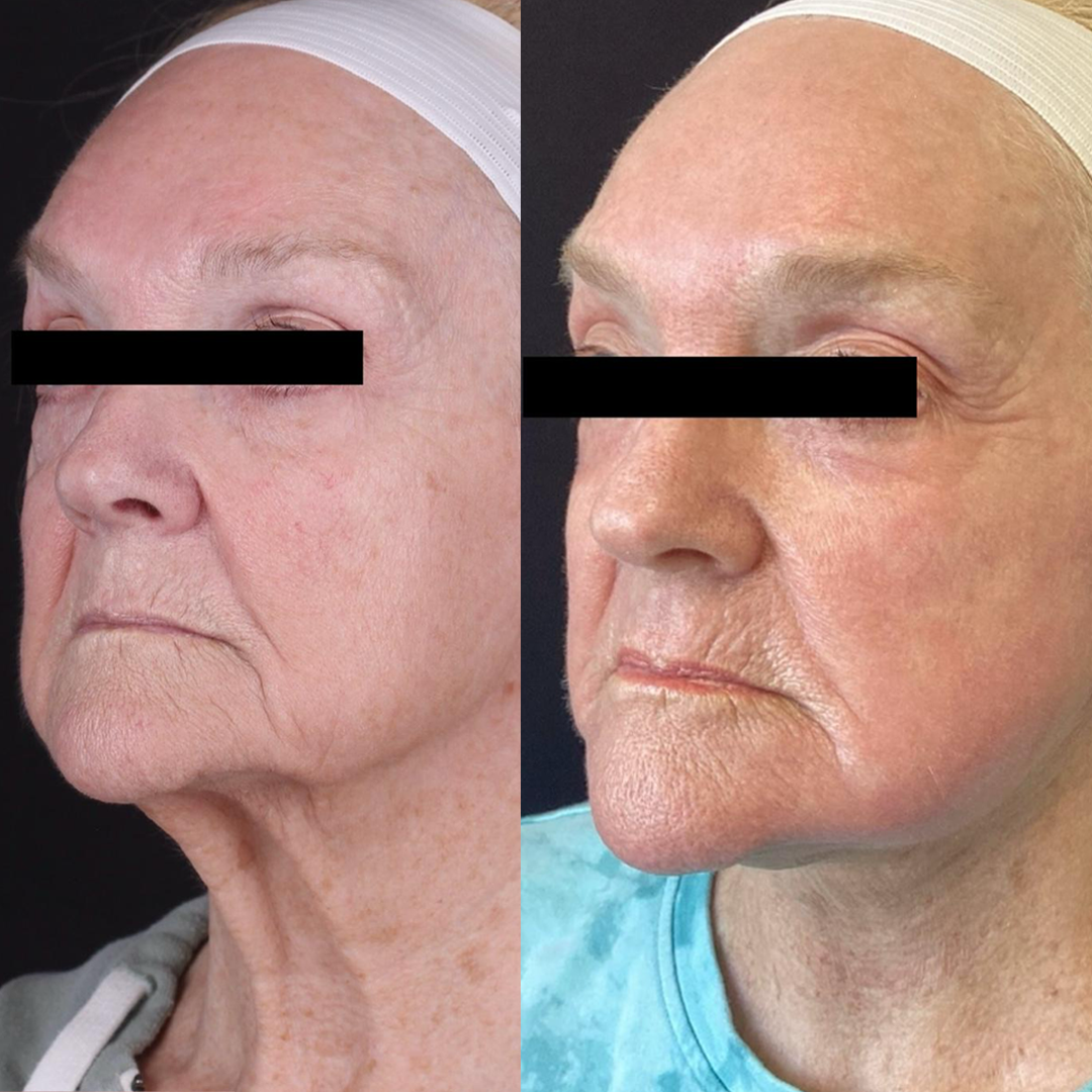 Real patient results before and after plastic surgery results in Beverly Hills, CA, performed by Dr. Moy
