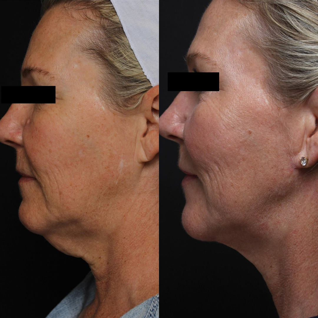 Real patient results before and after plastic surgery results in Beverly Hills, CA, performed by Dr. Moy