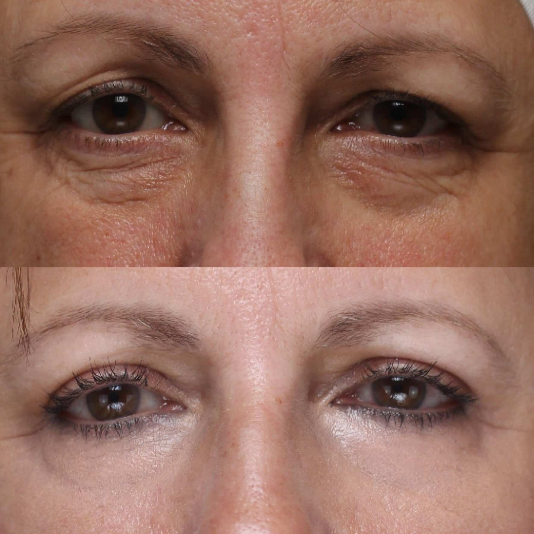 Real patient results before and after plastic surgery results in Beverly Hills, CA, performed by Dr. Moy