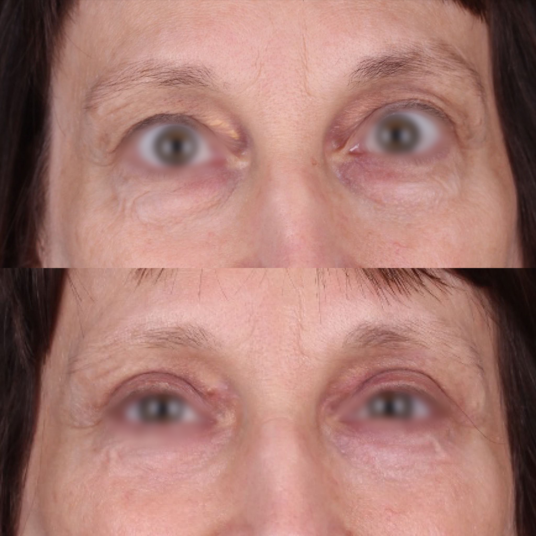 Real patient results before and after plastic surgery results in Beverly Hills, CA, performed by Dr. Moy