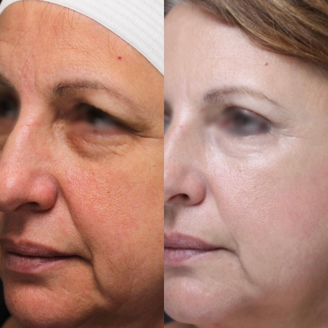 Real patient results before and after plastic surgery results in Beverly Hills, CA, performed by Dr. Moy
