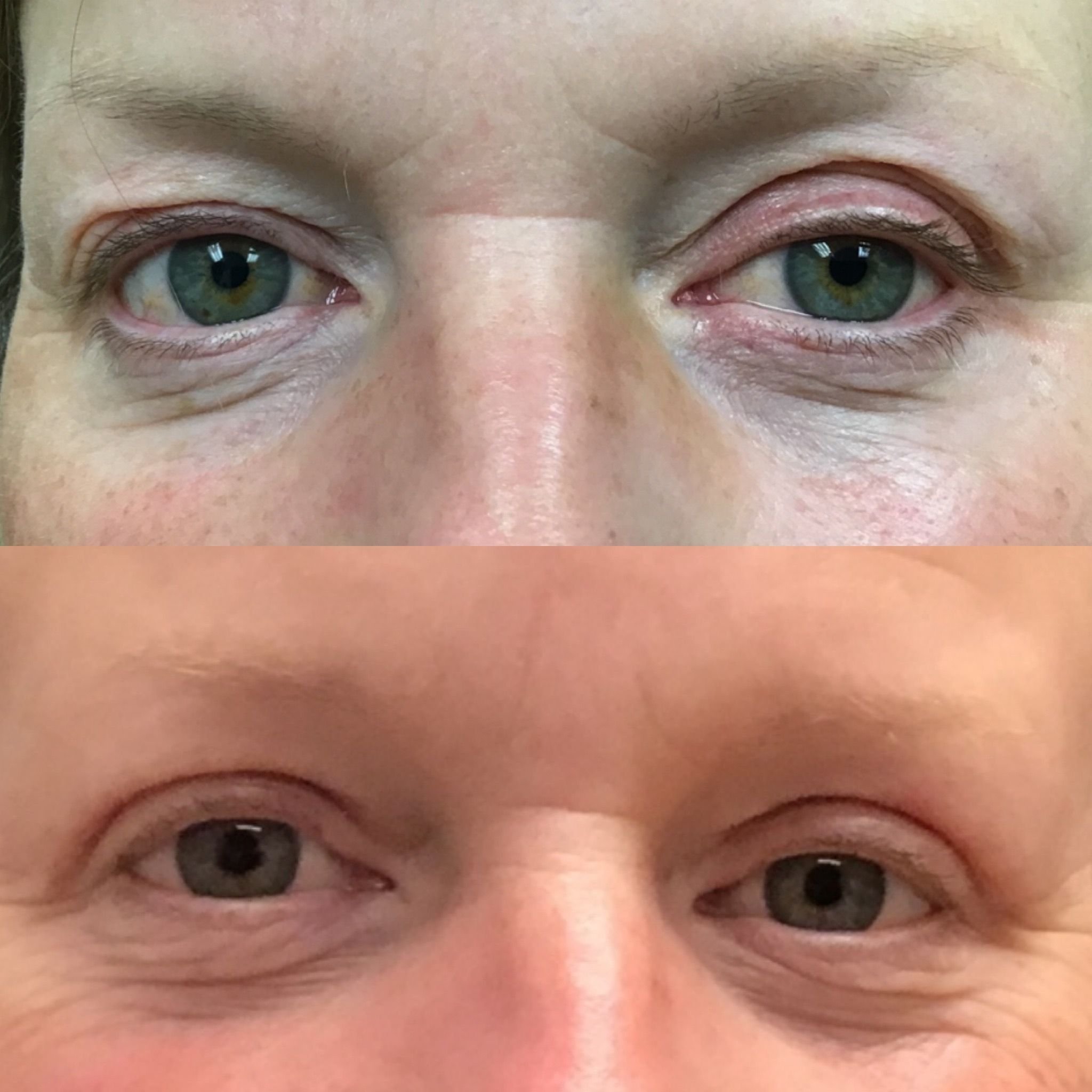 Real patient results before and after plastic surgery results in Beverly Hills, CA, performed by Dr. Moy