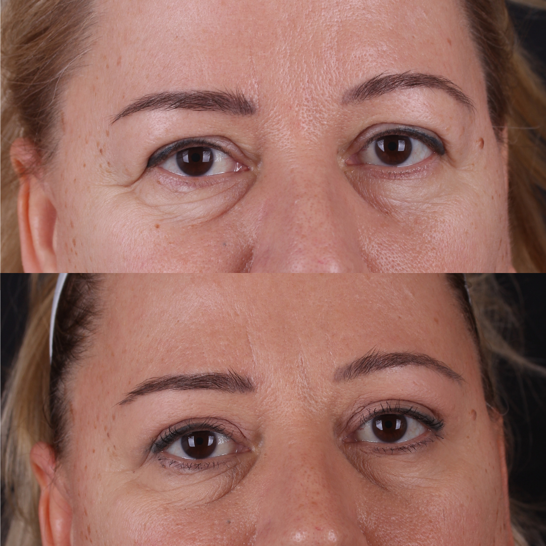 Real patient results before and after plastic surgery results in Beverly Hills, CA, performed by Dr. Moy