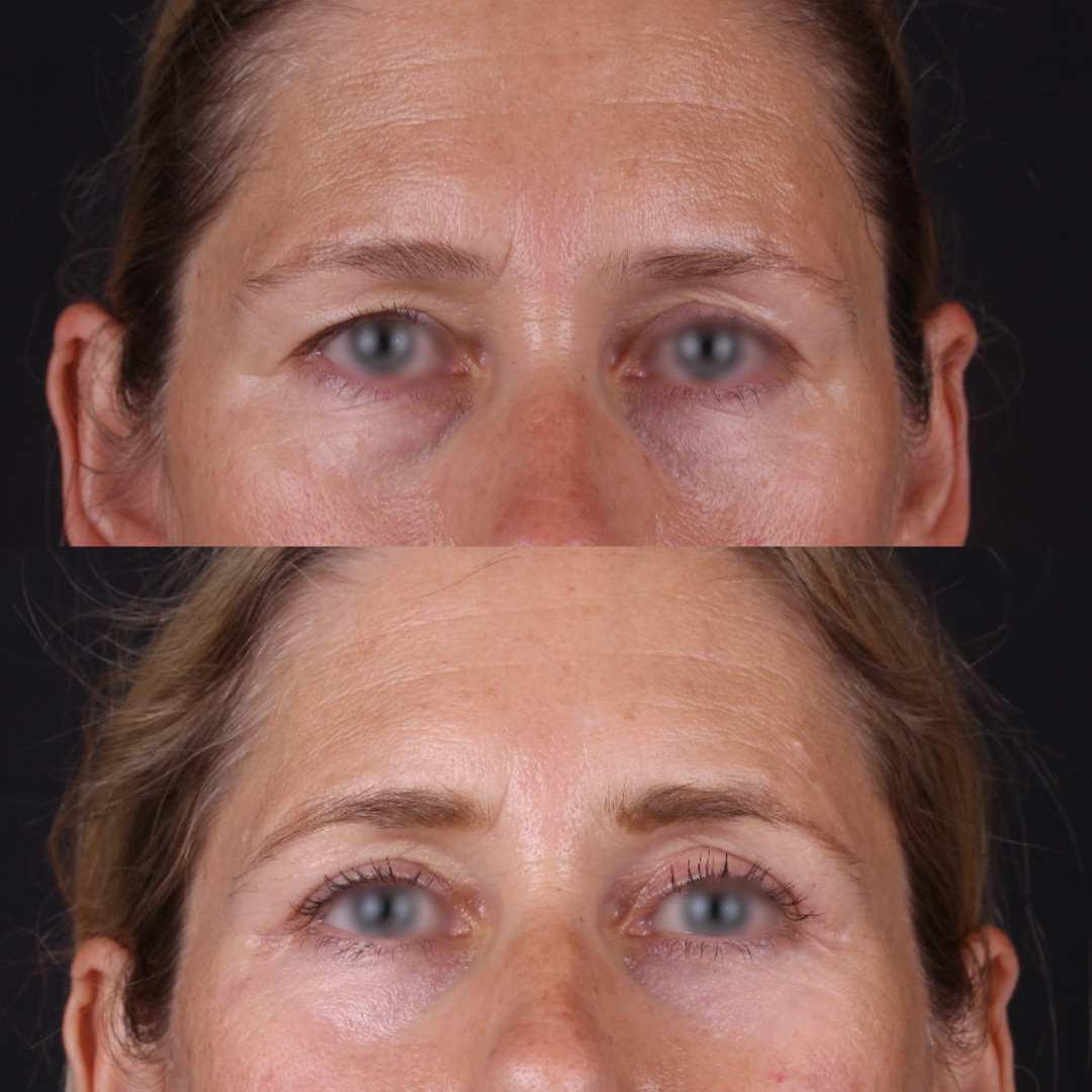 Real patient results before and after plastic surgery results in Beverly Hills, CA, performed by Dr. Moy
