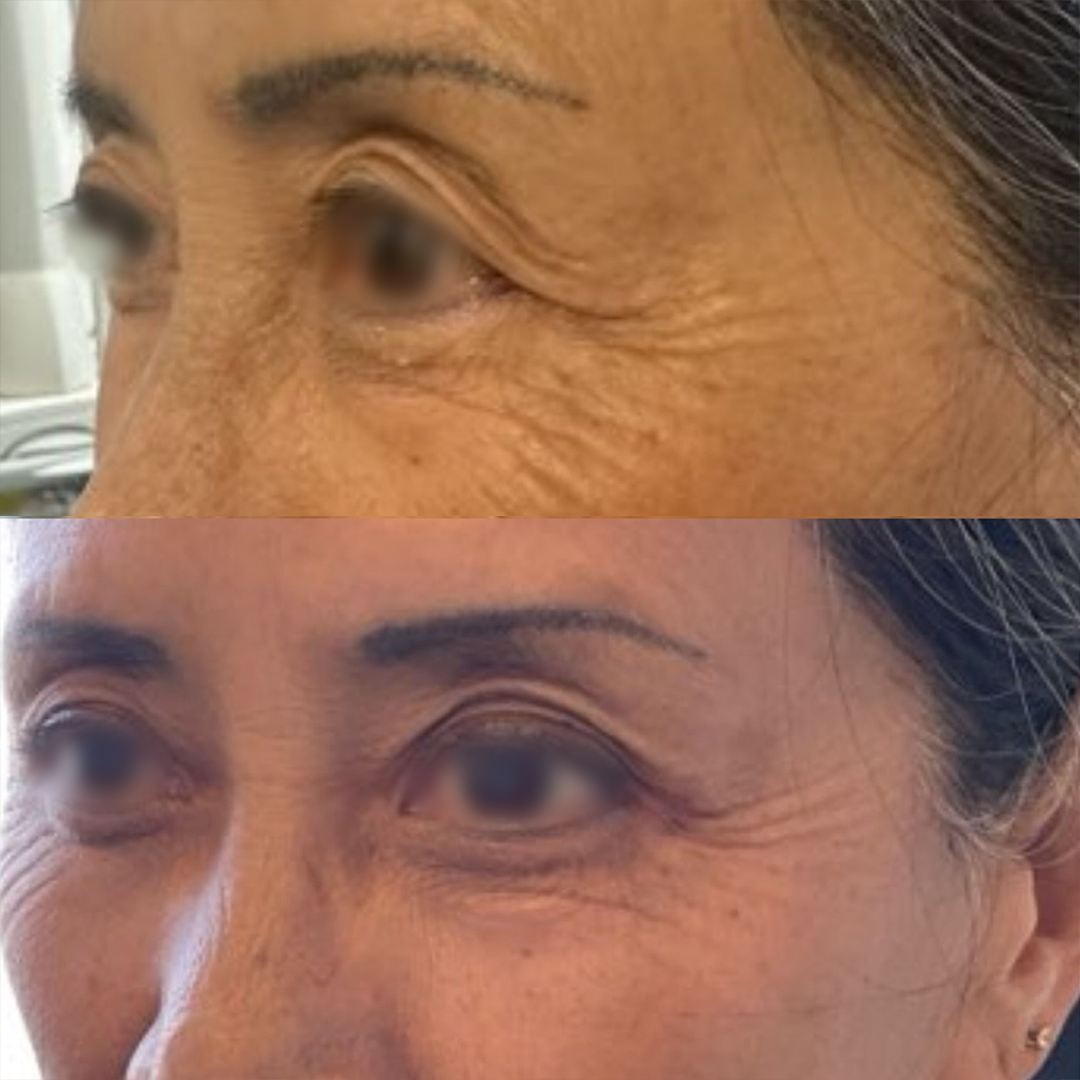 Real patient results before and after plastic surgery results in Beverly Hills, CA, performed by Dr. Moy