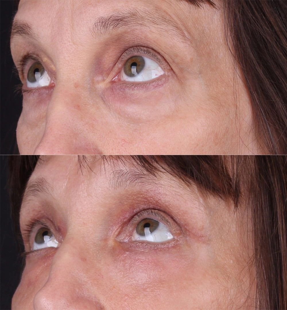 Real patient results before and after plastic surgery results in Beverly Hills, CA, performed by Dr. Moy