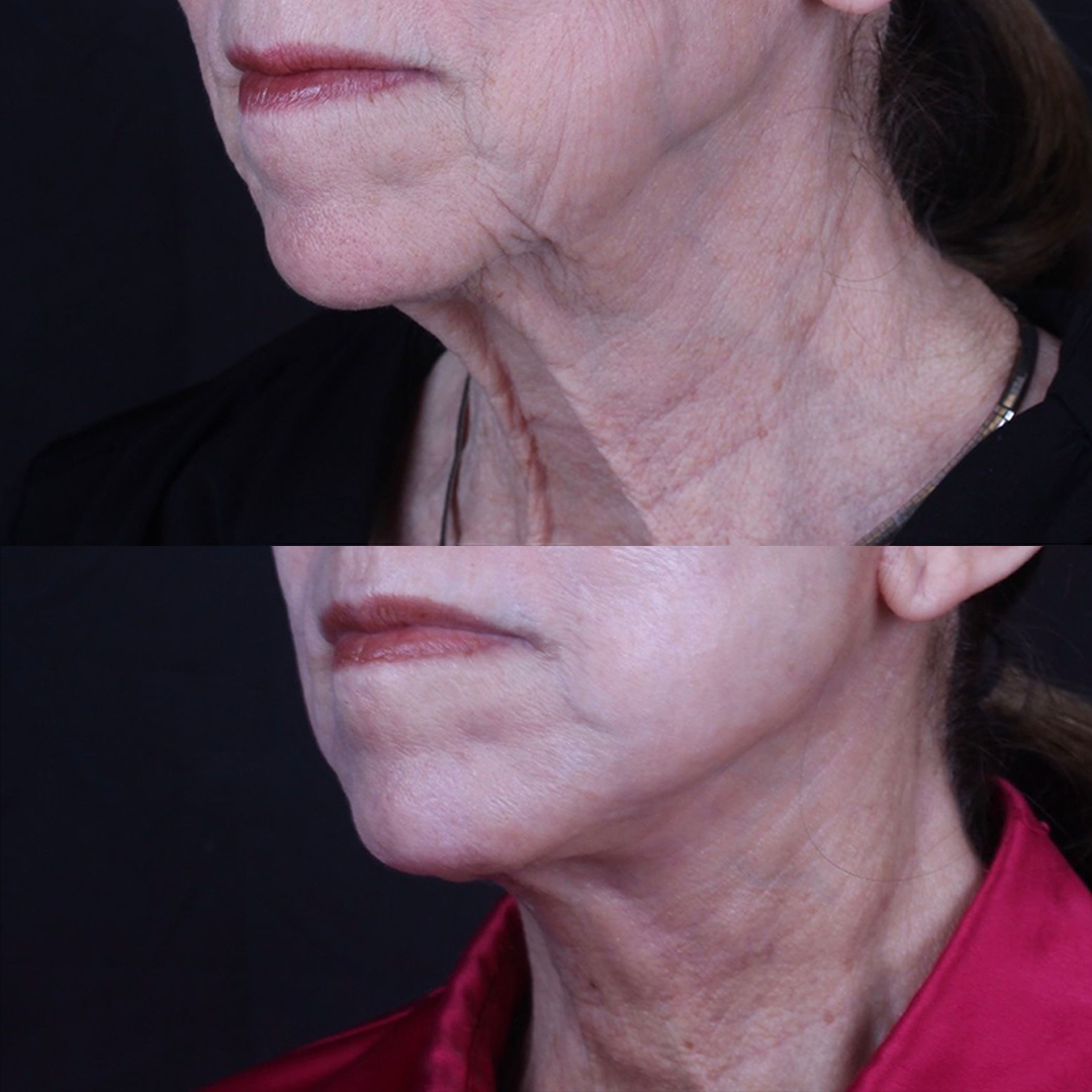 Real patient results before and after plastic surgery results in Beverly Hills, CA, performed by Dr. Moy