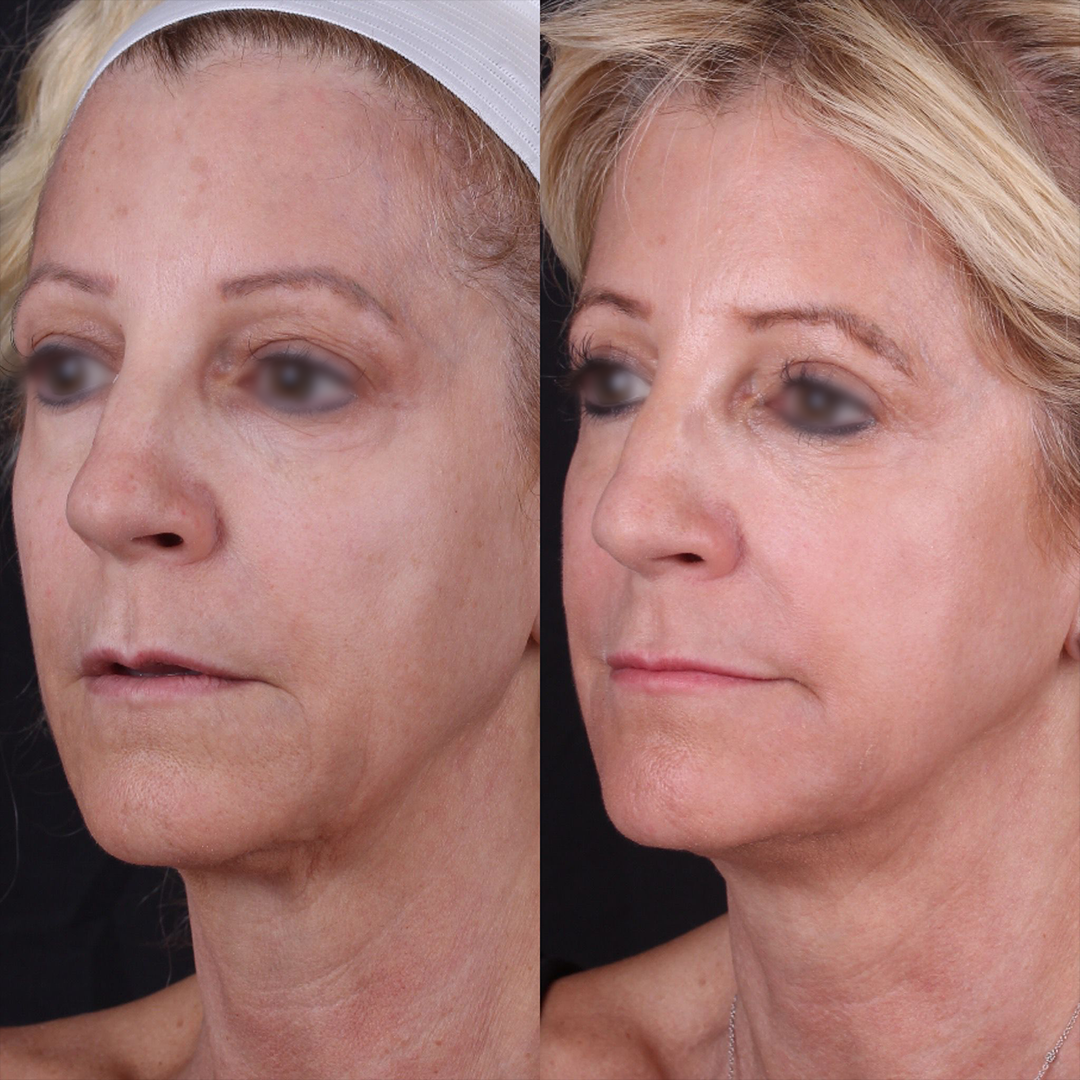Real patient results before and after plastic surgery results in Beverly Hills, CA, performed by Dr. Moy