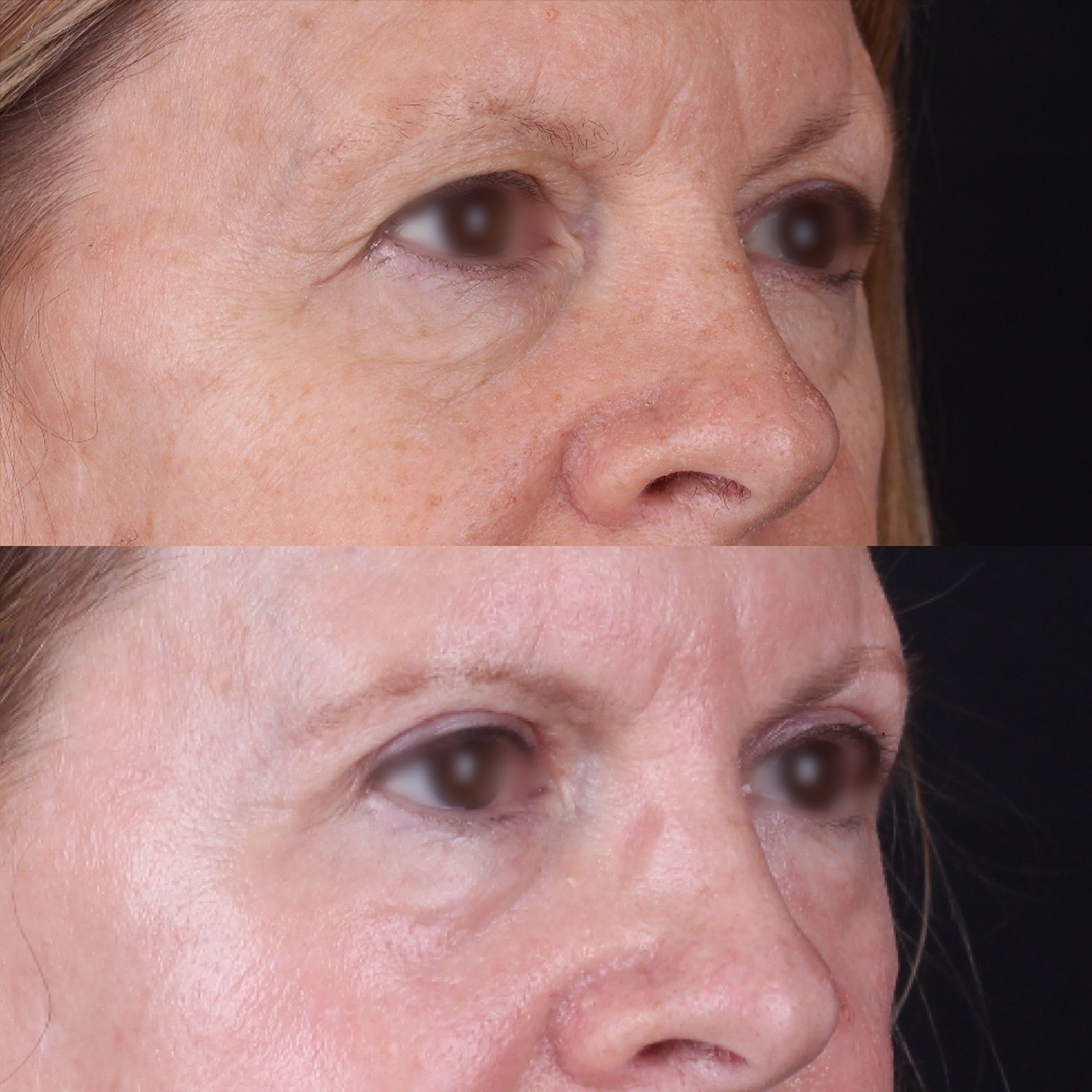 Real patient results before and after plastic surgery results in Beverly Hills, CA, performed by Dr. Moy