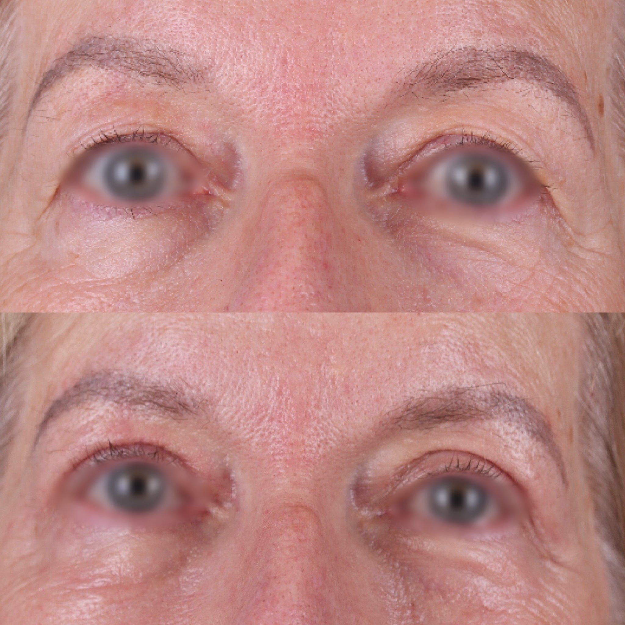 Real patient results before and after plastic surgery results in Beverly Hills, CA, performed by Dr. Moy