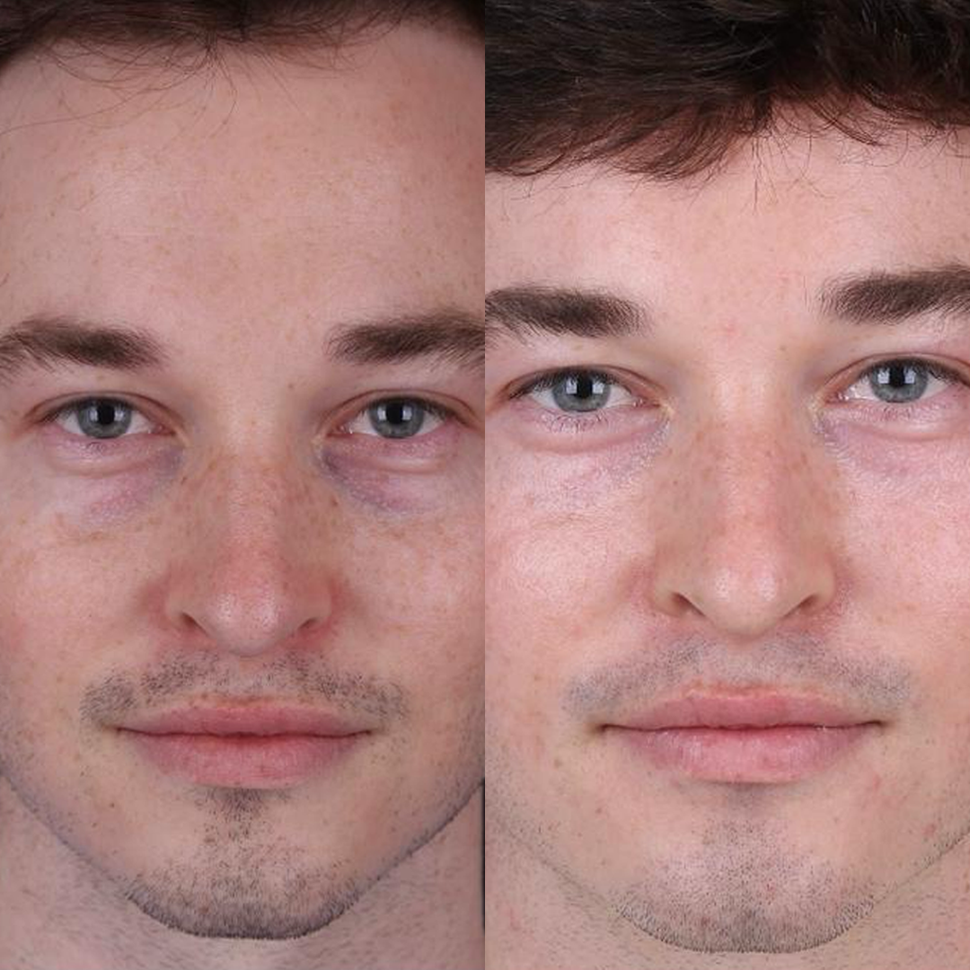 Real patient results before and after plastic surgery results in Beverly Hills, CA, performed by Dr. Moy