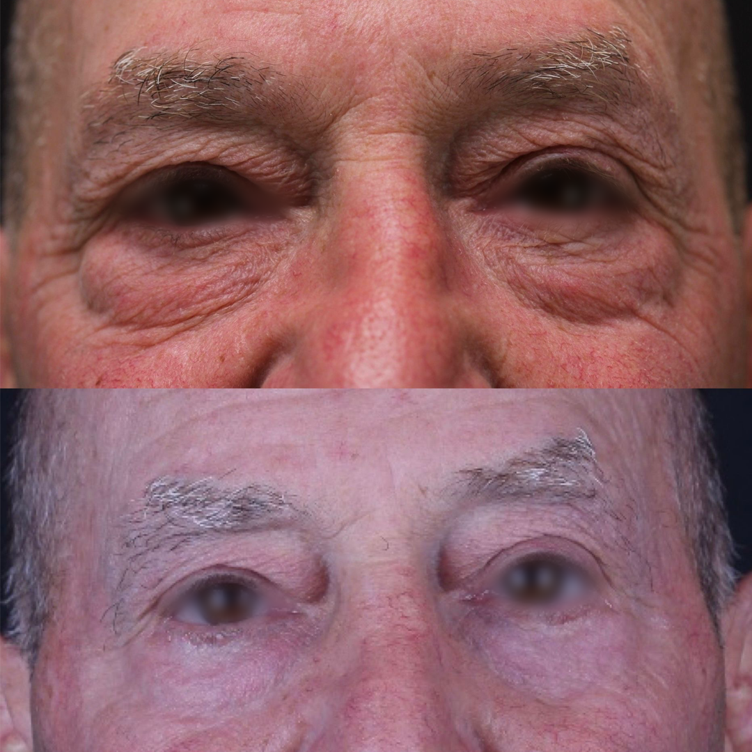 Real patient results before and after plastic surgery results in Beverly Hills, CA, performed by Dr. Moy