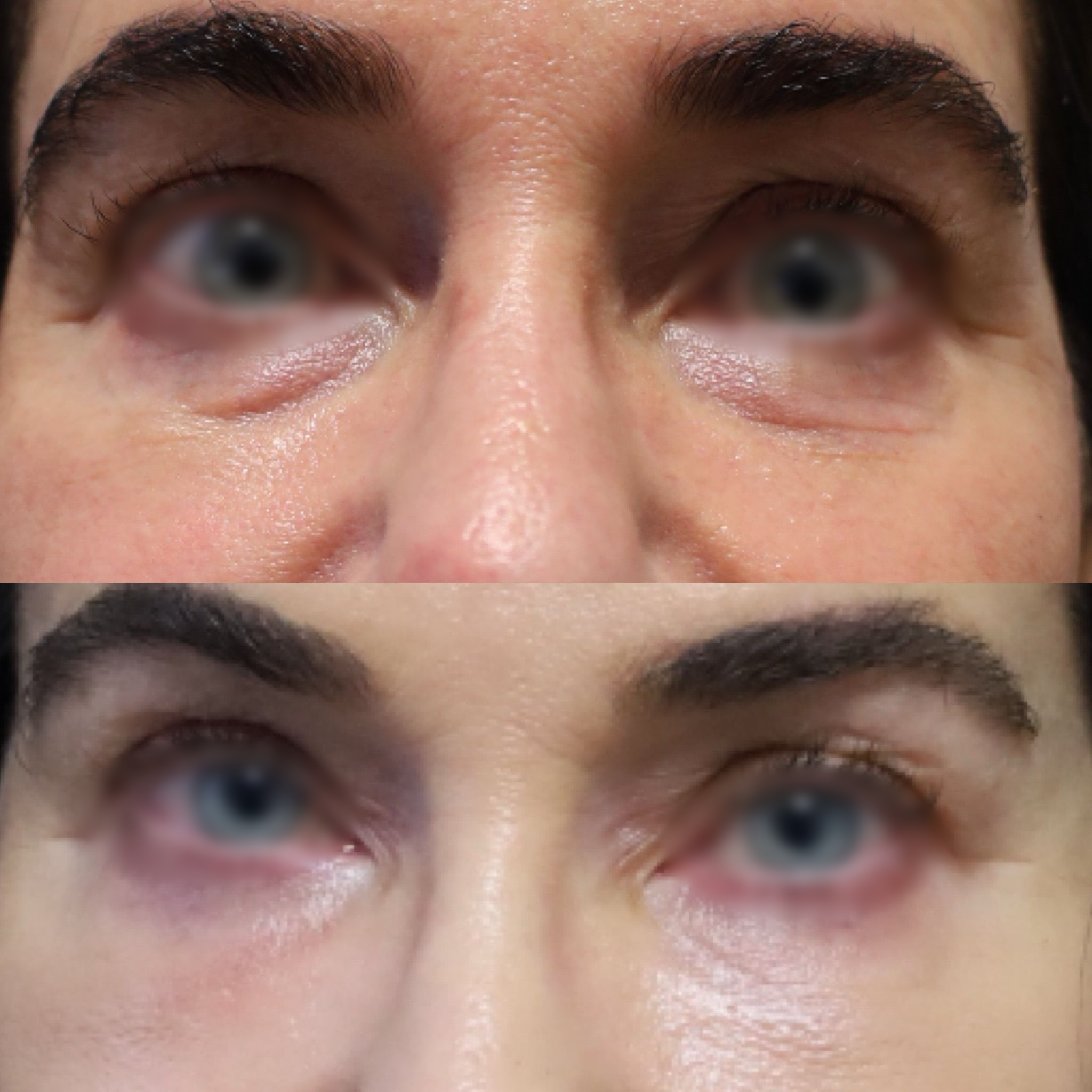 Real patient results before and after plastic surgery results in Beverly Hills, CA, performed by Dr. Moy