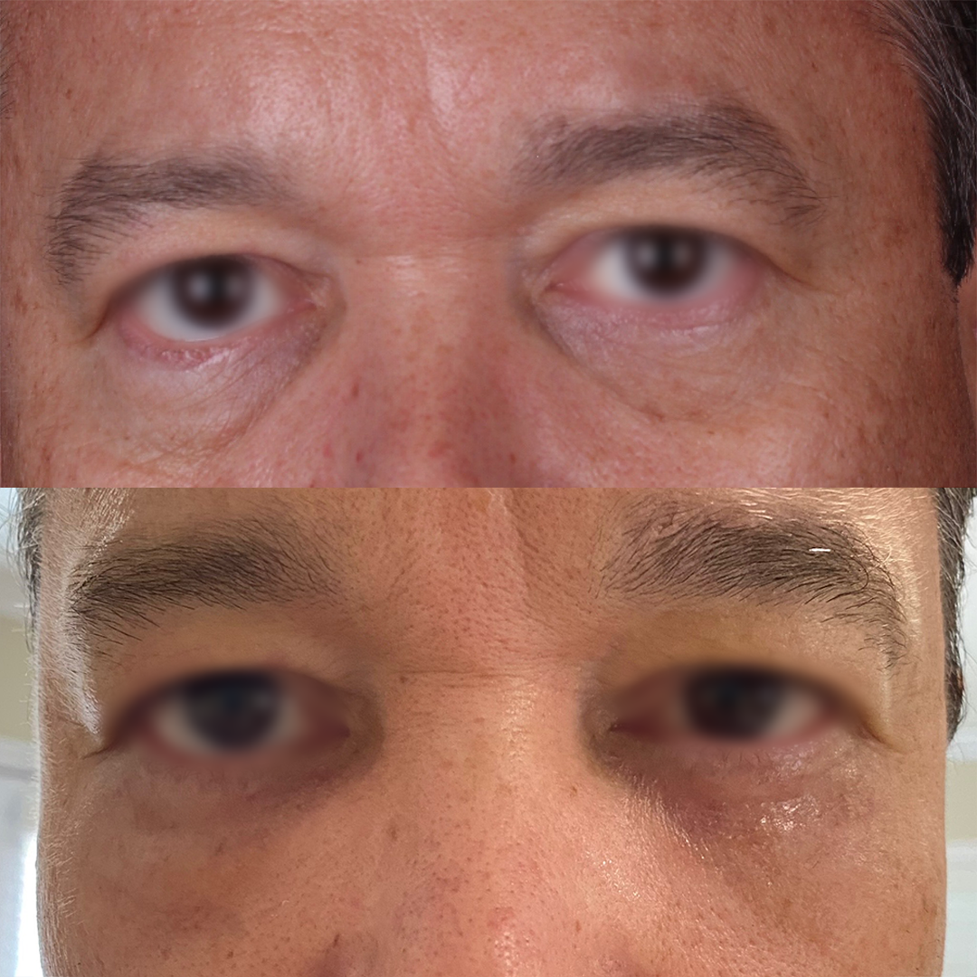Real patient results before and after plastic surgery results in Beverly Hills, CA, performed by Dr. Moy