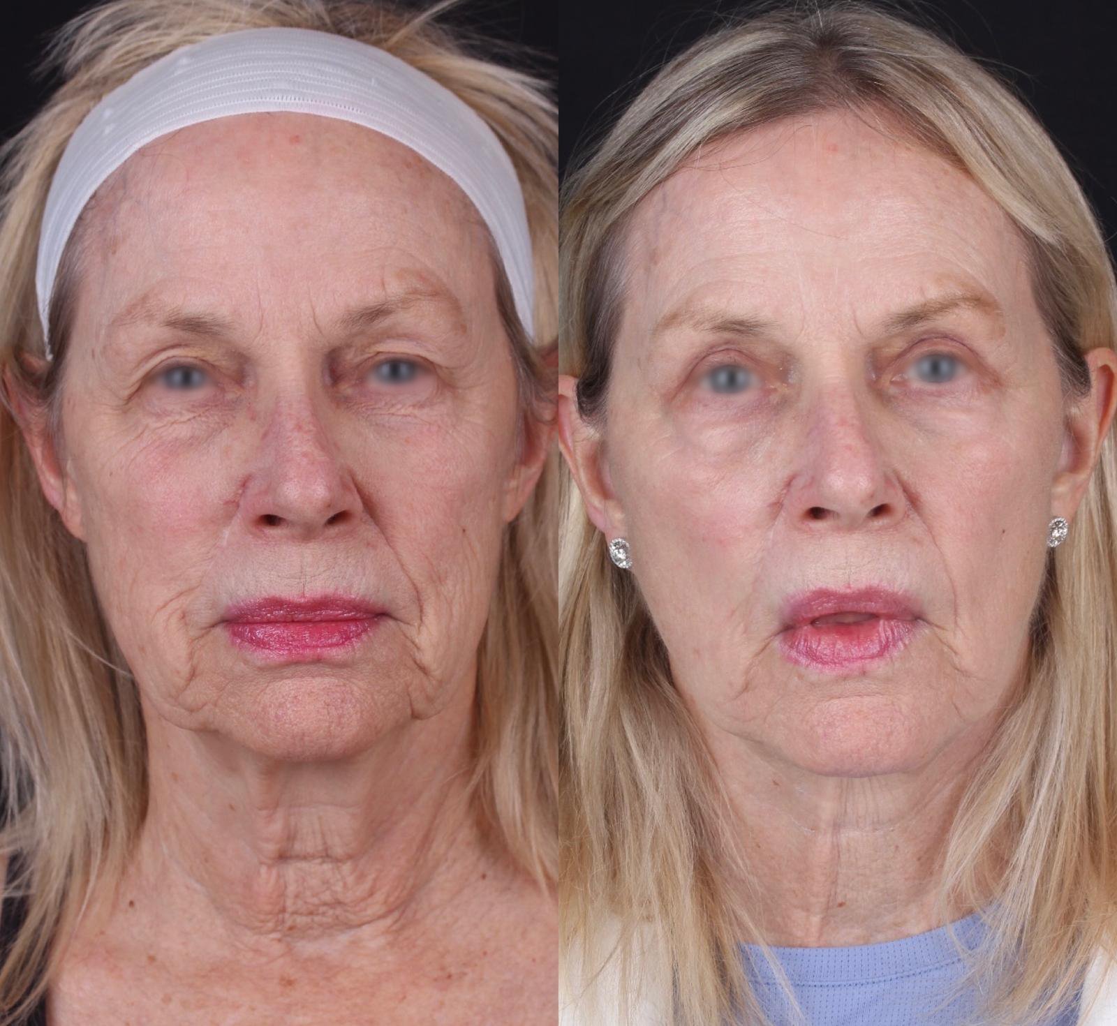Real patient results before and after plastic surgery results in Beverly Hills, CA, performed by Dr. Moy