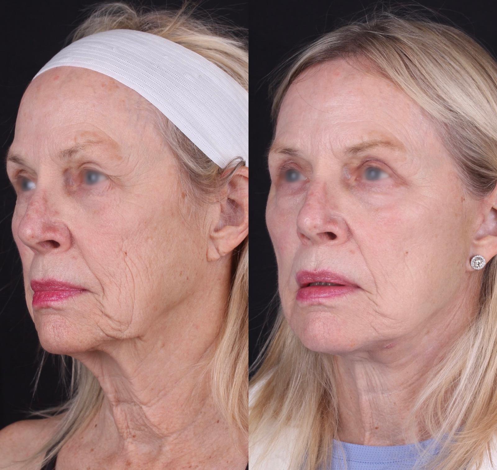 Real patient results before and after plastic surgery results in Beverly Hills, CA, performed by Dr. Moy