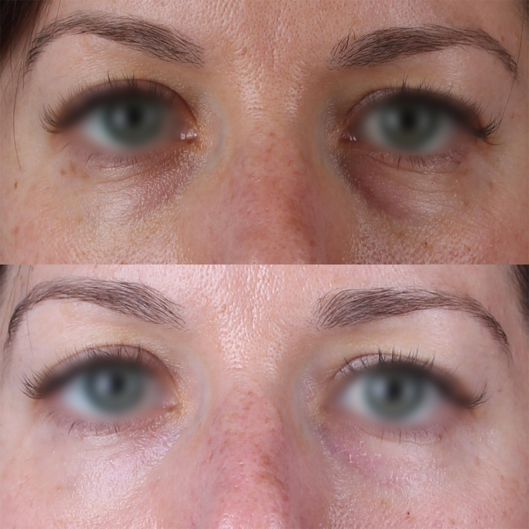 Real patient results before and after plastic surgery results in Beverly Hills, CA, performed by Dr. Moy