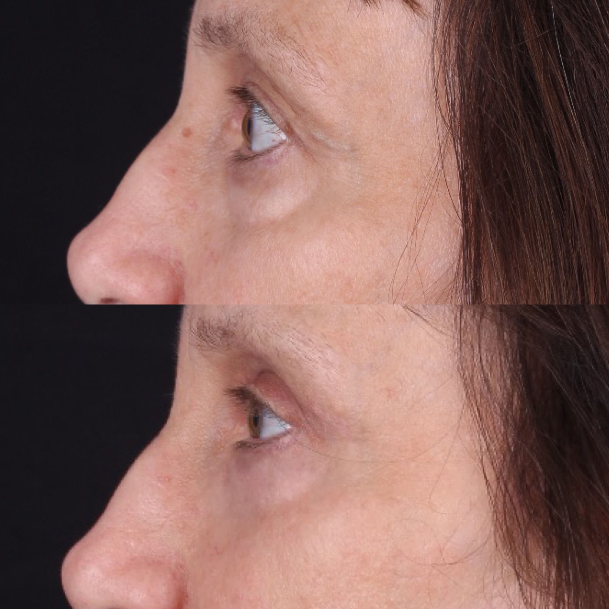 Real patient results before and after plastic surgery results in Beverly Hills, CA, performed by Dr. Moy