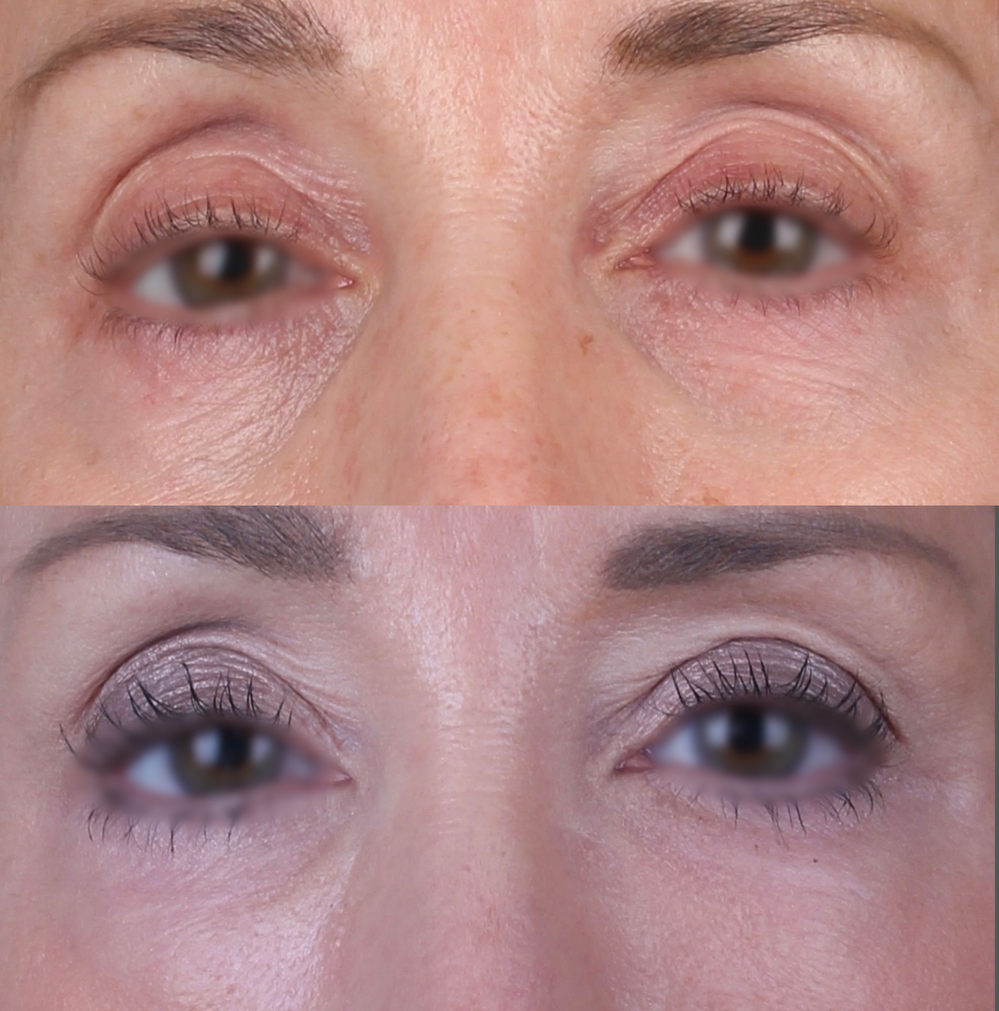 Real patient results before and after plastic surgery results in Beverly Hills, CA, performed by Dr. Moy