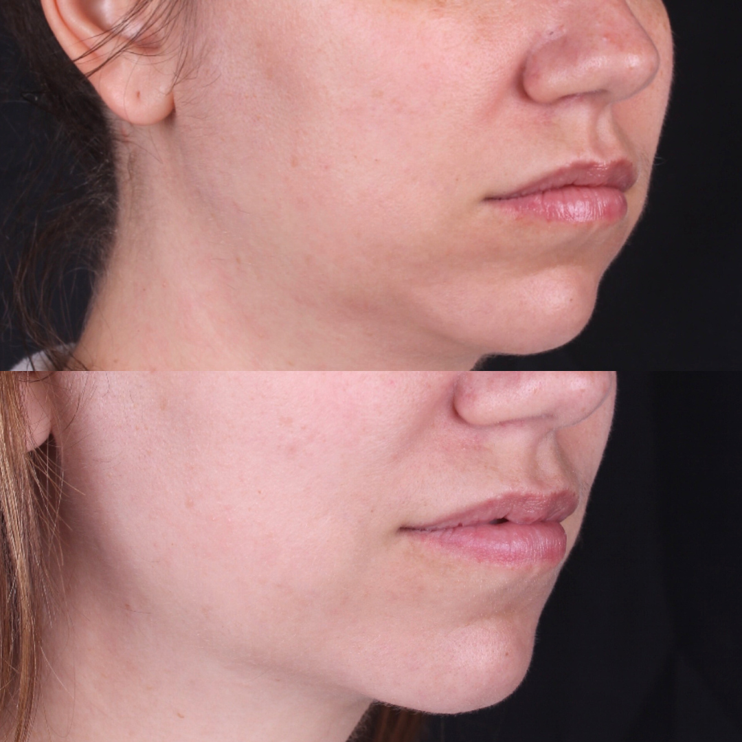 Real patient results before and after plastic surgery results in Beverly Hills, CA, performed by Dr. Moy