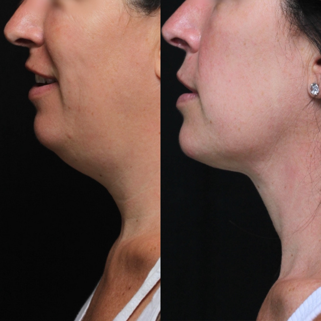 Real patient results before and after plastic surgery results in Beverly Hills, CA, performed by Dr. Moy