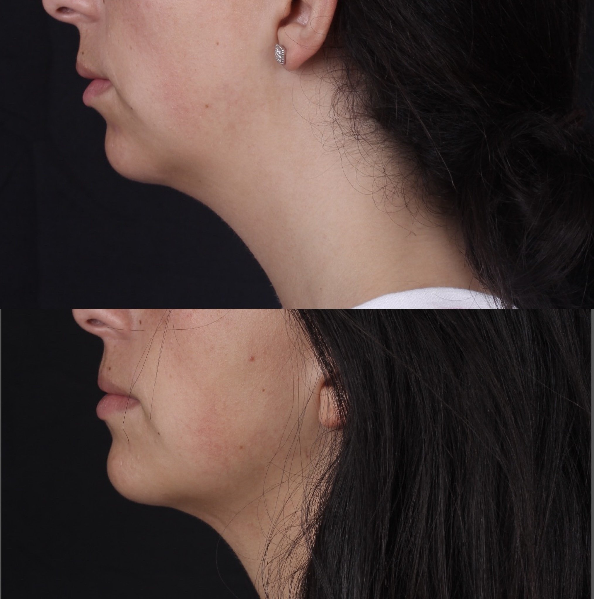 Real patient results before and after plastic surgery results in Beverly Hills, CA, performed by Dr. Moy