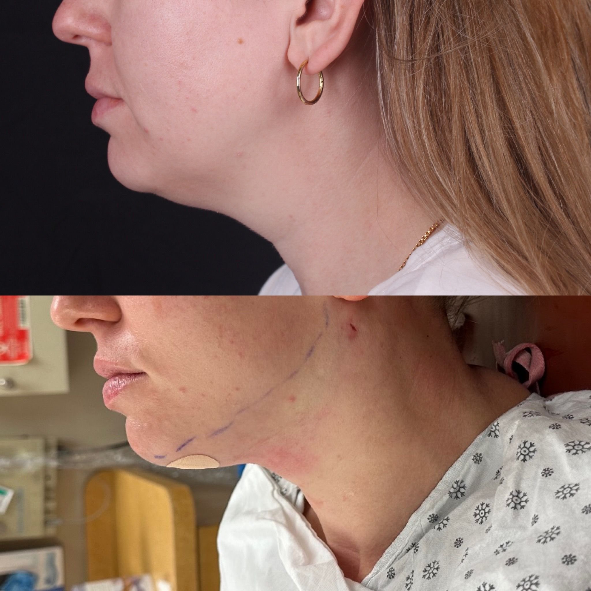 Real patient results before and after plastic surgery results in Beverly Hills, CA, performed by Dr. Moy