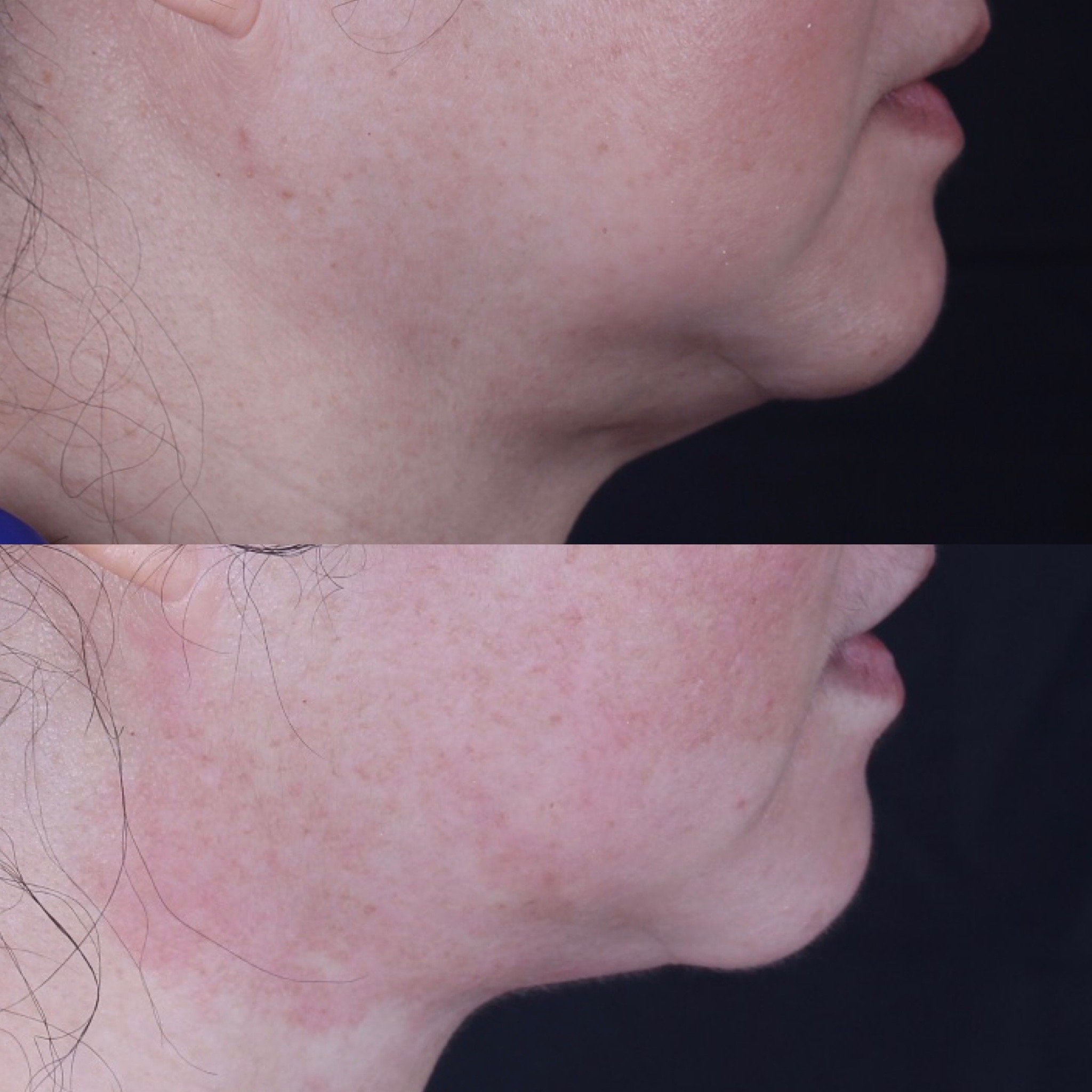 Real patient results before and after plastic surgery results in Beverly Hills, CA, performed by Dr. Moy