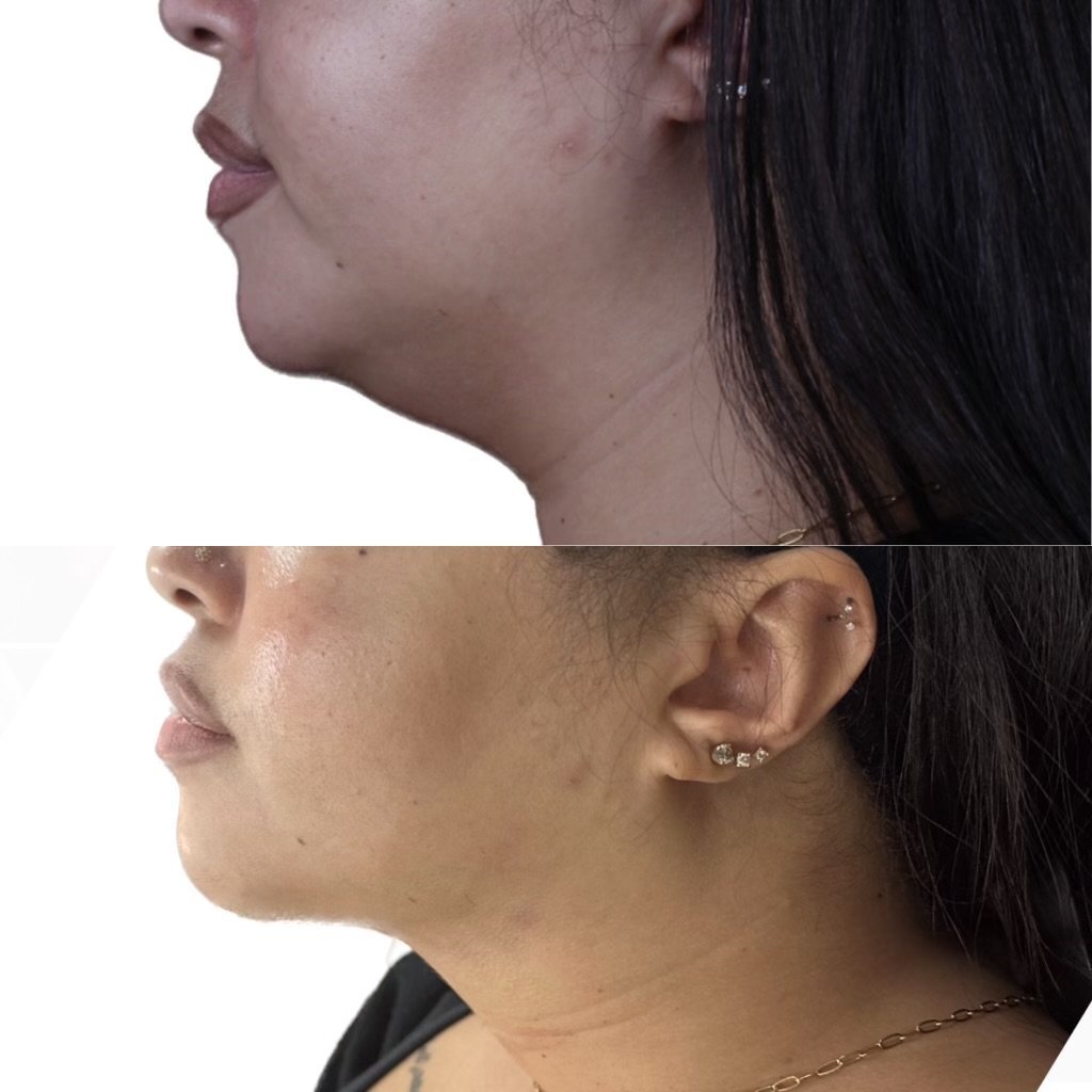 Real patient results before and after plastic surgery results in Beverly Hills, CA, performed by Dr. Moy