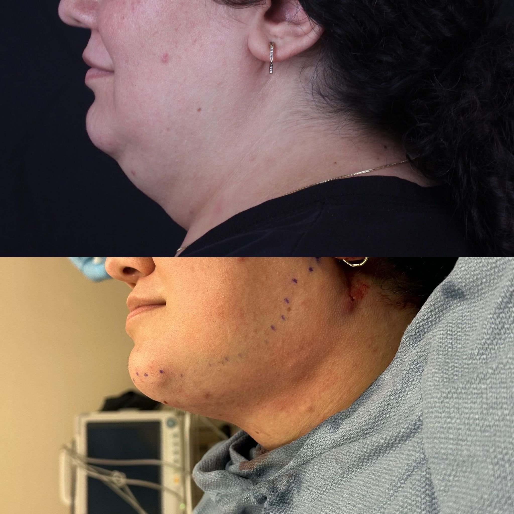 Real patient results before and after plastic surgery results in Beverly Hills, CA, performed by Dr. Moy