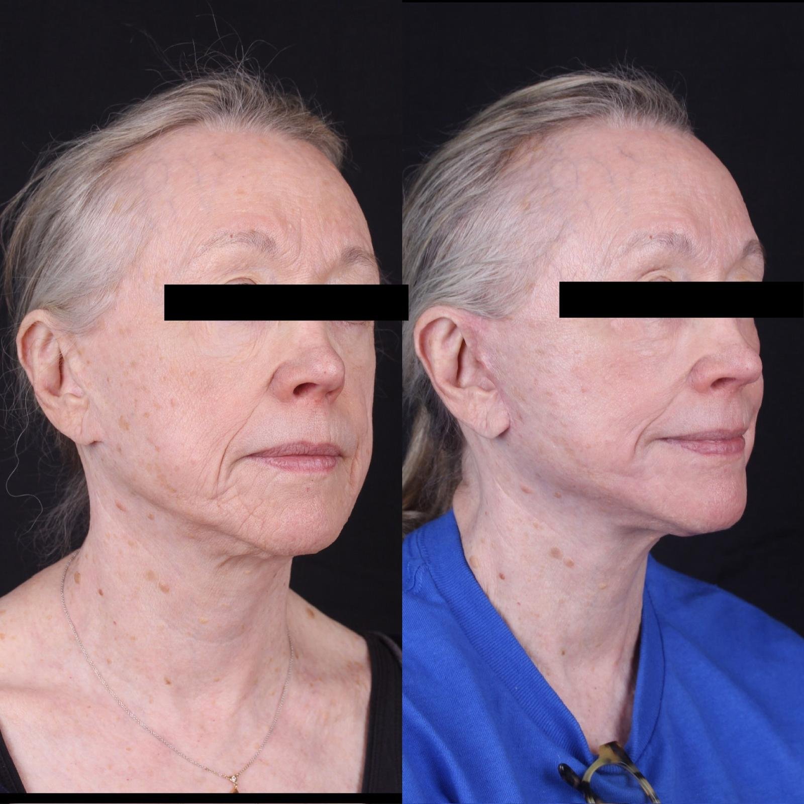 Real patient results before and after plastic surgery results in Beverly Hills, CA, performed by Dr. Moy
