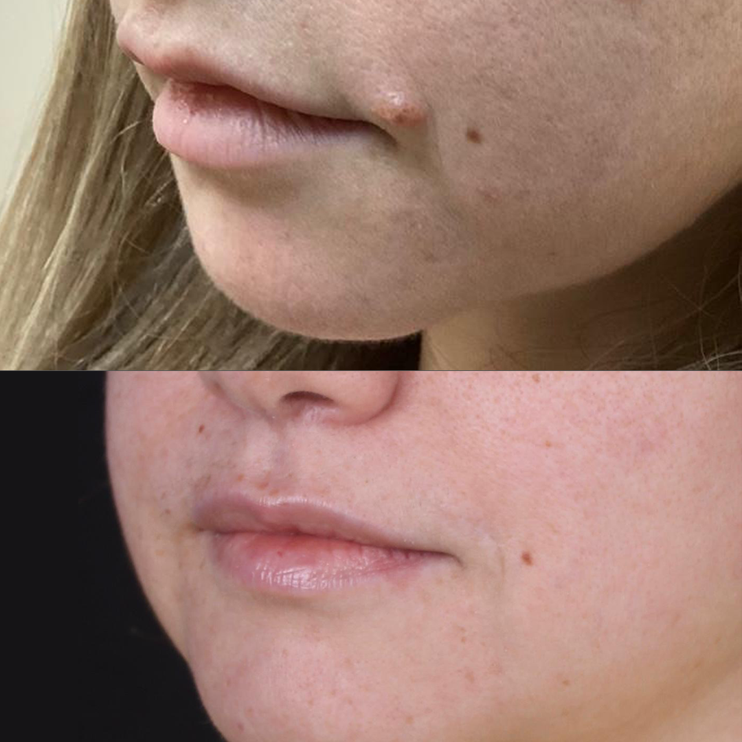 Real patient results before and after plastic surgery results in Beverly Hills, CA, performed by Dr. Moy