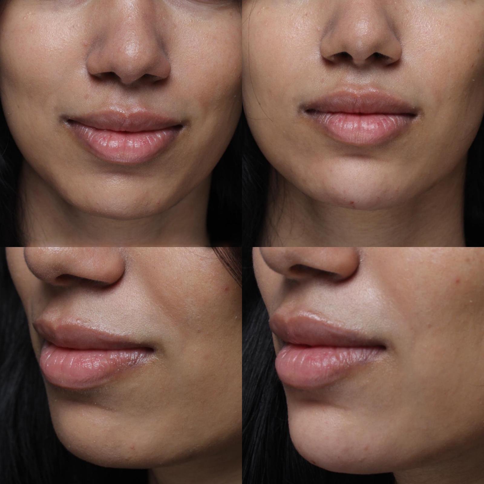 Real patient results before and after plastic surgery results in Beverly Hills, CA, performed by Dr. Moy