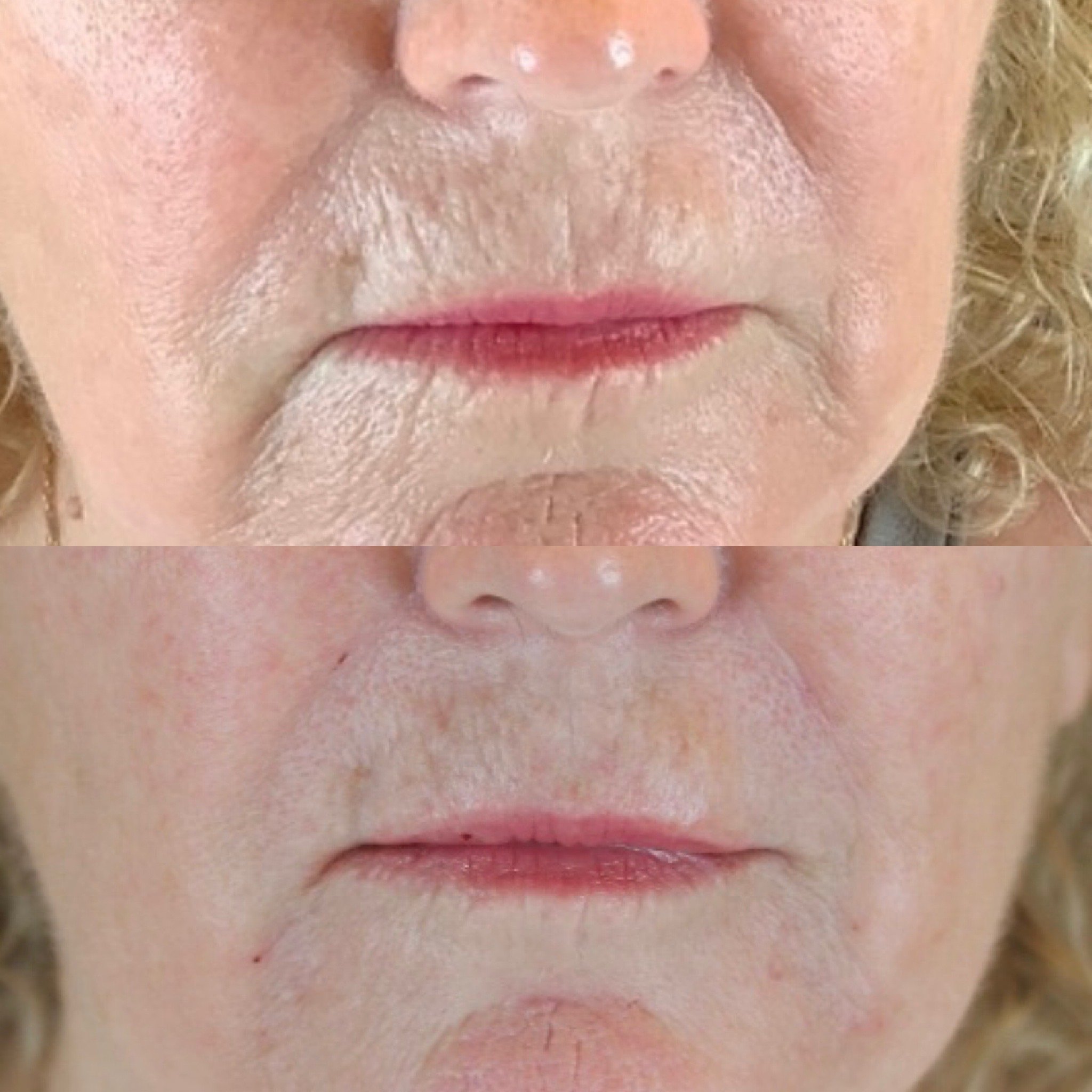 Real patient results before and after plastic surgery results in Beverly Hills, CA, performed by Dr. Moy