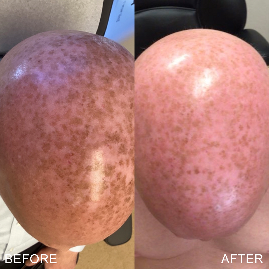 57moymdbeforeafterPiqoErbiumLaser-flipped-label