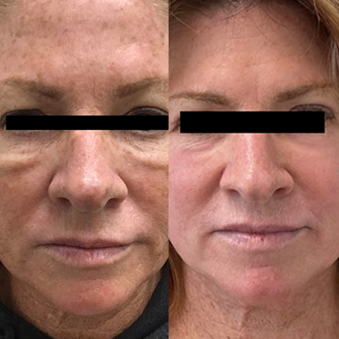 Real patient results before and after plastic surgery results in Beverly Hills, CA, performed by Dr. Moy