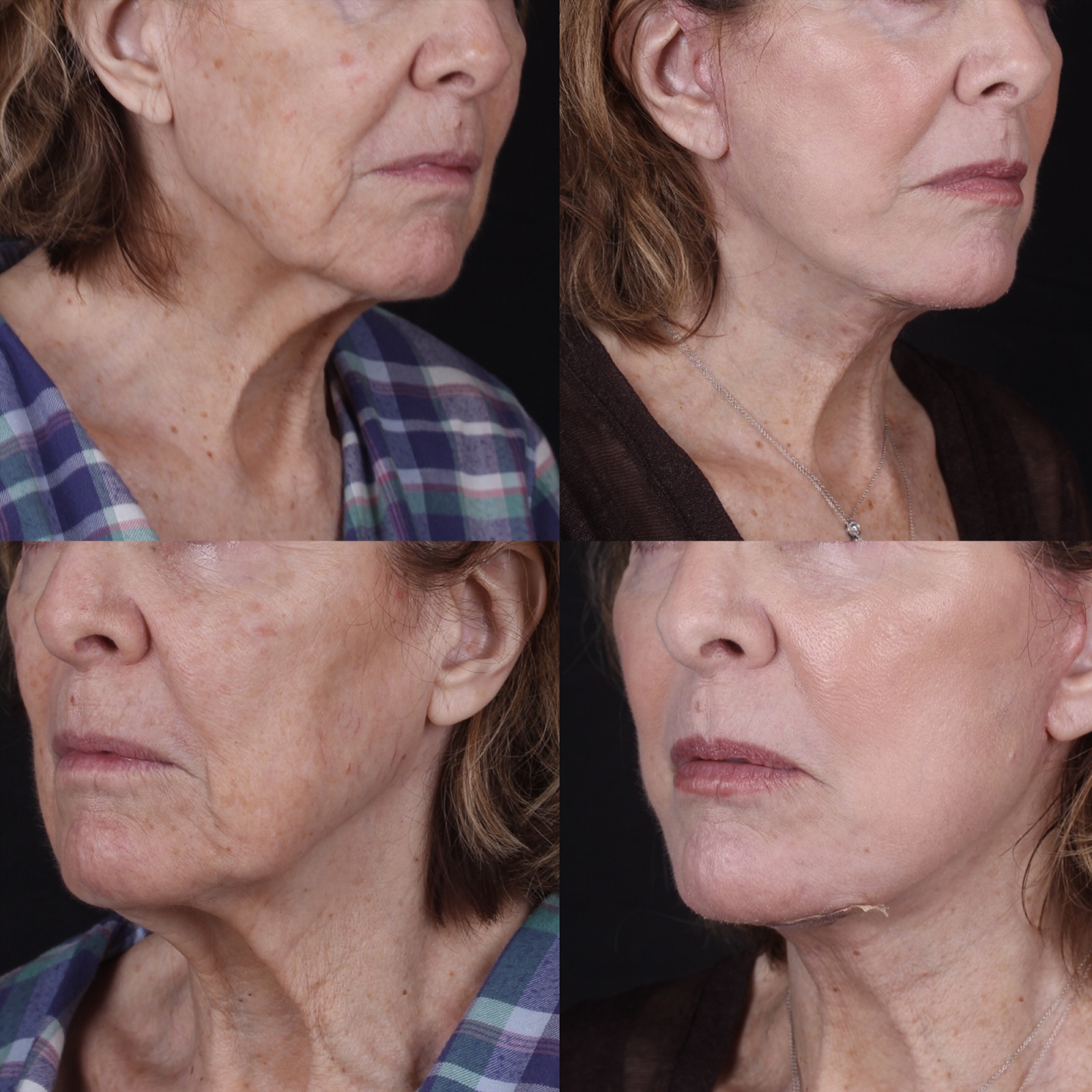 Real patient results before and after plastic surgery results in Beverly Hills, CA, performed by Dr. Moy