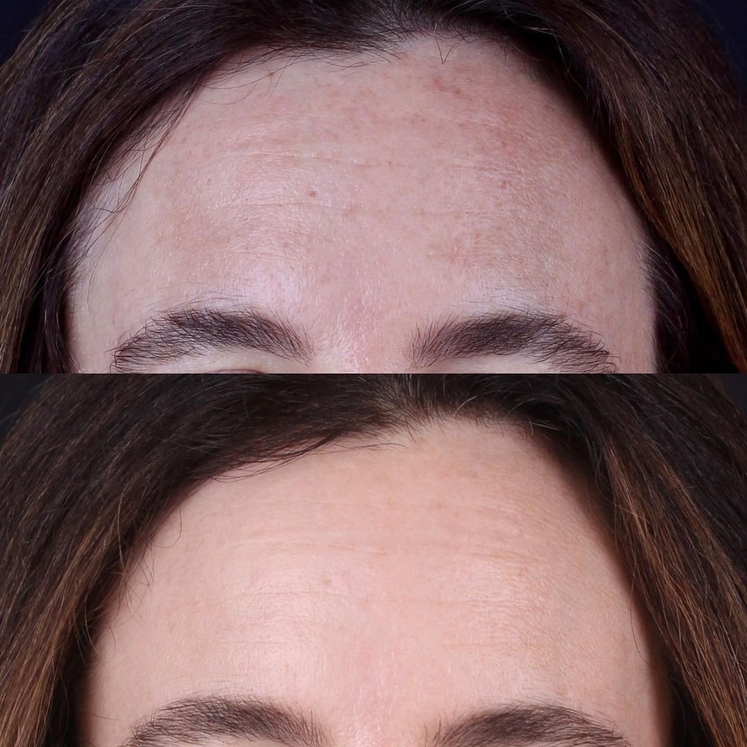 Real patient results before and after plastic surgery results in Beverly Hills, CA, performed by Dr. Moy