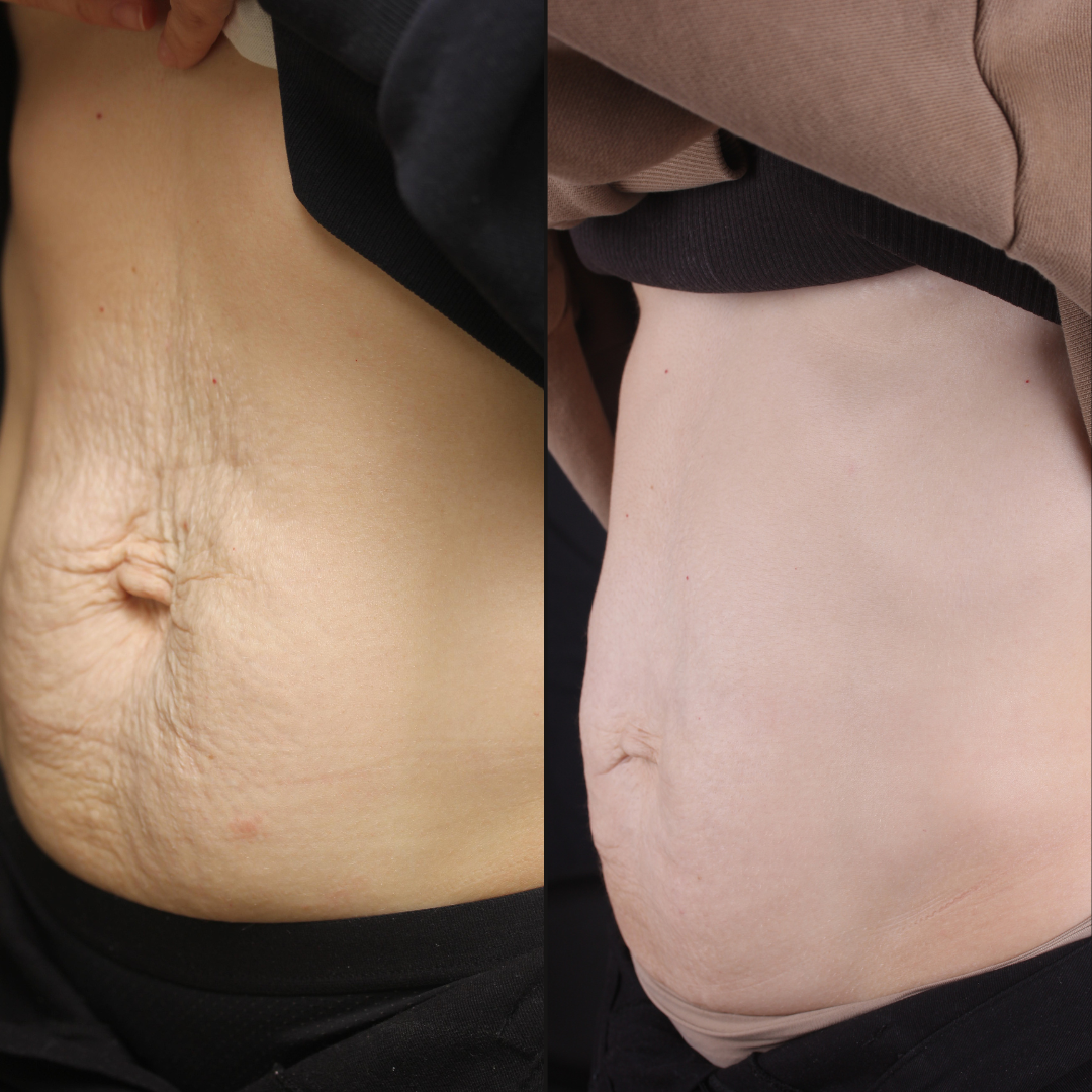 Real patient results before and after plastic surgery results in Beverly Hills, CA, performed by Dr. Moy