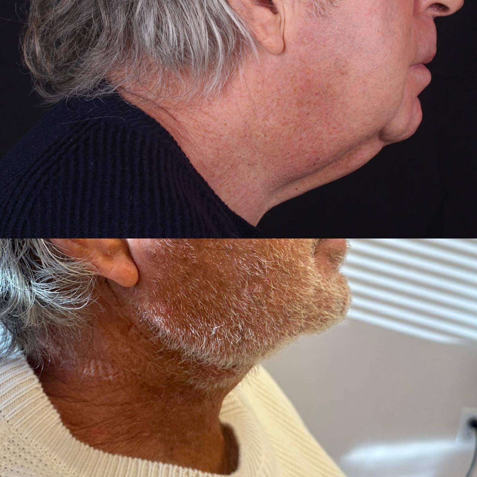 Real patient results before and after plastic surgery results in Beverly Hills, CA, performed by Dr. Moy
