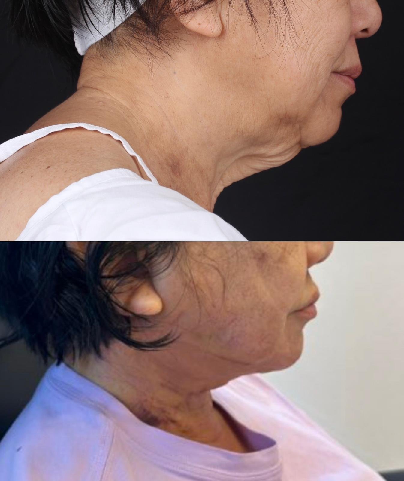 Real patient results before and after plastic surgery results in Beverly Hills, CA, performed by Dr. Moy
